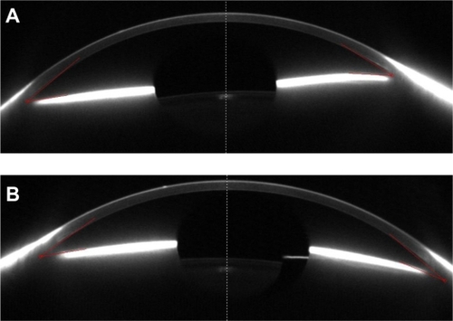 Figure 1 Pentacam image showing a silicone NewColorIris implant in the anterior chamber in the (A) right eye, with close apposition with the angle and (B) left eye, with asymmetry within the anterior chamber relative to the angle.