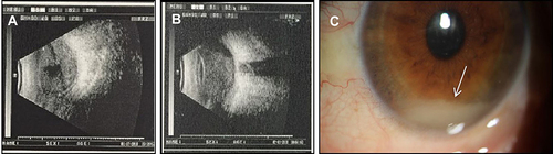 Figure 2 Professional medical examination with ophthalmological imaging showed the presence of hypopyon. (A) A color ultrasound image of the eyeball upon admission, with a large volume of pus in the vitreous cavity. (B) Color ultrasound image of the eyeball before enucleation, with extensive pus accumulation in the vitreous cavity, which had worsened significantly. (C) The patient presented with mild swelling of the left eyelid, hyperemia of the eye, mild edema of the left cornea, and an anterior atrial abscess, about 2 mm in depth (white arrow).