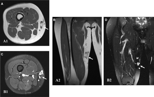 Figure 2 Preoperative magnetic resonance imaging showing multiple elongated tubular tracts in subcutaneous tissue of thigh.