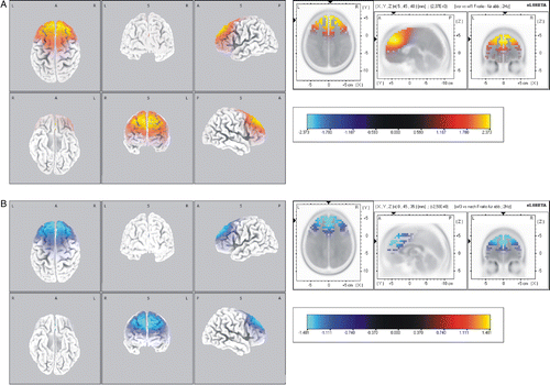 Figure 4 Standardised low resolution brain electromagnetic tomography (sLORETA) differences in the EEG β1 frequency band during parabolic flight. Comparisons of (A) pre-flight activity and in-flight activity, and (B) in-flight activity and post-flight activity (B), respectively. Images depicting SPMs seen from different perspectives are based on voxel-by-voxel t-values of differences. Red colours indicate increased activity in the in-flight condition (A). Blue colours indicate decreased activity in the post-flight condition. Changes were found to be localised in the frontal lobe and medial frontal gyrus. Structural anatomy is shown in grey scale (L left, R right, A anterior, P posterior).