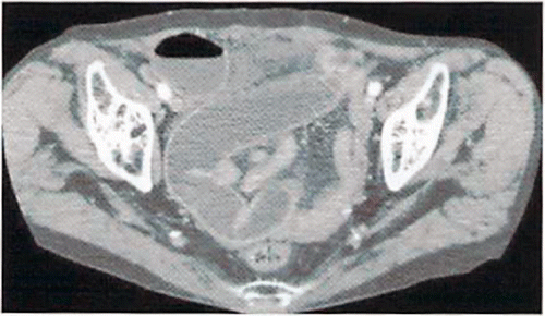 Figure A.7. Abdominal contrast-enhanced computed tomography (case 5, low-abdomen level).