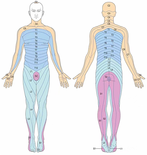 Figure 3 The picture shows the distribution of the skin nodes in the innervated area, and the distribution of the nerve skin nodes involving C2-S1 in herpes zoster patients is located in one limb.