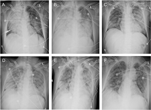 Figure 2. Chest radiographs during the clinical course. Bilateral ground-glass opacity and consolidation were observed on day 9 (Dec 26, Panel A) and worsened on day 11 (Dec 28, Panel B). Bilateral lung involvement was slightly relieved on day 14 (Dec 31, Panel C) after methylprednisolone was administrated on day 11. Bilateral ground-glass opacity and consolidation continued till day 16 (Jan 2, Panel D) and day 18 (Jan 4, Panel E) and relieved slightly on day 20 (Jan 6, Panel F).