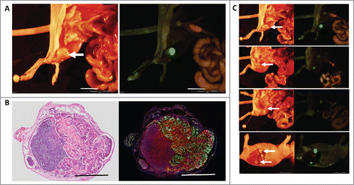 Figure 1. (A) Inguinal lymph node metastasis. The white arrow indicates an inguinal lymph node metastasis (left). Green fluorescent protein (GFP) expression visualized the metastasis (right). ME180-GFP cells (1.5 × 106), co-transplanted s.c. with CAFs (0.6 × 106), formed inguinal lymph node metastasis after 8 weeks. GFP-labeled ME180 facilitated localization of the metastasis. White bar = 10 mm. (B) H&E and fluorescence images of lymph node metastasis. H&E staining (left). Fluorescence immunostaining of the inguinal-lymph-node metastasis (right). Normal lymph-node structure can be seen in the deep purple area that is darkly-stained in the H&E section (left). ME180/GFP cells were labeled with GFP and lymphocytes were immunoreacted with an anti-LCA antibody labeled with Alexa594 (red) (right). Metastatic ME180 cells occupied a large area of the lymph node. DAPI, with blue fluorescence, labeled the cell nuclei (right). Bars = 1 mm. (C) White arrows indicate the lymph node metastasis.