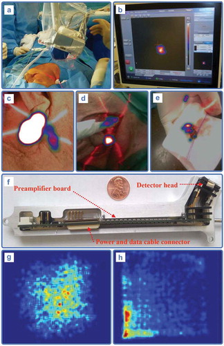 Figure 2. 2D portable nuclear detection cameras. (a–b) Portable gamma camera imaging during SN procedure for head and neck melanoma with ICG-99mTc-nanocolloid (from [Citation253Citation254]). (c–e) Augmented reality overlay of gamma camera findings within the anatomical context of the patient during head and neck cancer SN procedure (from [Citation255]). (f) Setup of a portable beta+ camera for radioguided surgery, with evaluation in a tongue tumor rabbit model showing uptake in primary tumor (g) and lymph nodes (h) using 18F-FDG (from [Citation162]).