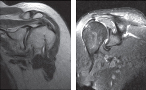 Examples of false-positive rotator cuff reads on MRI, highlighting the increased signaling near the supraspinatus with associated joint effusion, usually indicative of rotator cuff pathology.