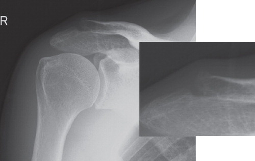 Figure 3. Case presentation. Plain radiographs showing osteosclerosis of the distal end of the clavicle and a cyst in the subchondral bone indicate degenerative arthritis of the acromioclavicular joint.