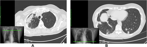 Figure 2 CT images showing findings of radiation recall pneumonitis. (A) A crazy-paving pattern and thickening pulmonary interstitium on the apex of right lung. (B) Thickening of the right lung included in breast tangential fields and ground glass opacities (GGO) spread in both lungs.