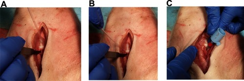 Figure 4 A dissected view and example of a wide approach of the CTT procedure. The cricothyroid ligament is incised (A). Urinary catheter is placed (B). A size 3.5 uncuffed endotracheal tube is placed into the incision (C).