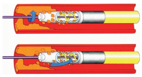 Figure 1 The Rotarex® system.