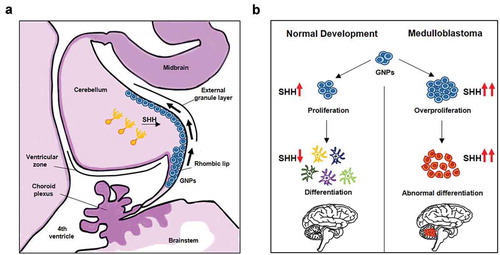 Figure 1. Cells of origin of SHH-MB. (A) The figure depicts the cerebellum development at embryonic early stage. Under SHH stimuli secreted from Purkinje cells (orange), granule neuron precursors (GNPs, blue) migrate from the rhombic lip to the external granule layer (EGL), then undergo the subsequent differentiation and migration into the inner granule layer (IGL). (B) Schematic representation of SHH-induced GNPs development, and its deregulation in the tumorigenesis of MB