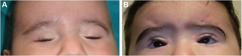 Figure 3 (A) Preoperative and (B) postoperative result of frontalis sling procedure in a case of severe ptosis.