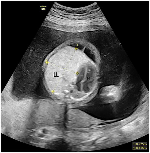 Figure 1. Fetal US at 23 gestational weeks. Left lung (LL) measuring 5.25 × 3.58 cm, with vestigial right lung (RL), 1.0 × 1.5 cm, and cardiac dextroposition (H).
