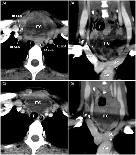 Figure 2. A 37-year-old female had left grade 1 and type A ITG. (A) Axial enhanced CT shows the main mass of ITG was in the prevascular region with right deviation and backward displacement of the trachea. (B) Coronal enhanced CT shows the inferior margin of ITG between the thoracic inlet and the aortic arch convexity. (C, D) Axial and coronal enhanced CT shows the regression change of ITG with decreased volume and enhancement of the main mass after RFA. (ITG: intrathoracic goiter; Ao: aorta; SCV: subclavian vein; SCA: subclavian artery; CCA: common carotid artery; T: trachea).