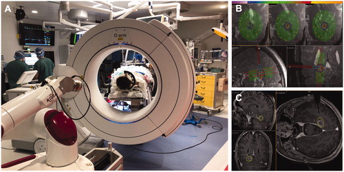 Figure 1. LITT operating room workflow. (A) At our center, bone fiducials and OArm CT are used for frameless registration. The robot is used for placement of the LITT guidance bolt. (B) Intra-ablation MR thermography provides online feedback demonstrating the extent of ablation. (C) Intra-operative post-ablation post-contrast T1-weighted MR showing ablation relative to MR thermography ablation volume.