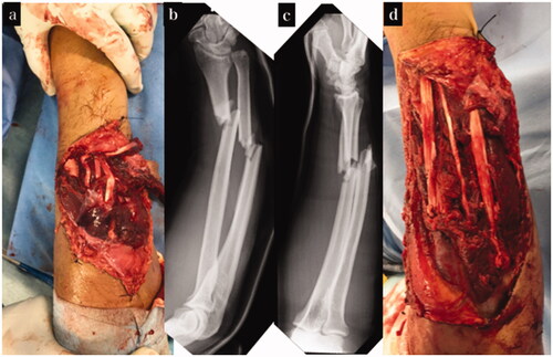 Figure 2. Treatment course of case 1. (a) Appearance on arrival at our hospital. (b,c) X-ray on arrival at our hospital. (d) Appearance after tendon reconstruction using pull-in sutures.