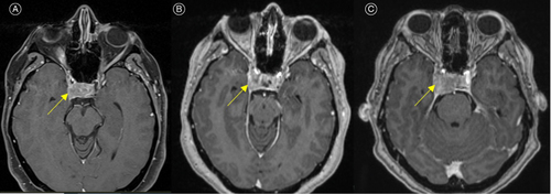 Figure 1. MRI brain T1 post-contrast axial images of the patient demonstrating a heterogeneously enhancing right anterior pituitary mass with mild to moderate suprasellar extension and involvement of the right cavernous sinus (yellow arrows). Images at presentation (A), at readmission four days later (B), and nine days after initial presentation pre-operatively (C).