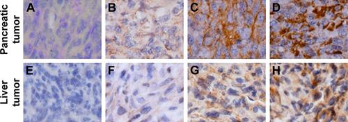 Figure S1 Immunohistochemical score of PD-L1 expression in pancreatic tumor and spontaneous liver metastases.Notes: (A–D) Images represent pancreatic tumors with IHC scores. (E–H) Images represent liver tumors with IHC scores. Scores are reported as follows: 0 (A, E) represents no staining, 1+(B, F) represents weak staining, 2+(C, G) represents moderate staining, and 3+(D, H) represents intense stainin. Images of A–H are ×400 magnification.