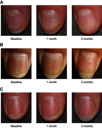 Figure 3 Clinical pictures showing the effect of the topical and/or oral biomineral formulation on lamellar splitting.Note: (A) Nail condition after treatment with topical formulation; (B) nail condition after treatment with oral supplement; (C) nail condition after treatment with topical formulation and oral supplement combined.