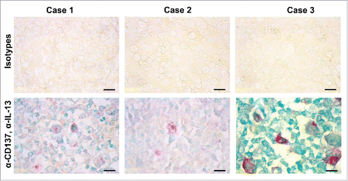 Figure 4. CD137-positive cells in HL express IL-13. Immunohistochemical detection of IL-13 (green) and CD137 (red). Shown are three cases of classical HL of the mixed cellularity type. Size bar: 10 μm.