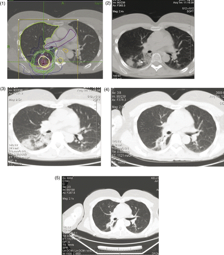 Figures 2. In lung tumor patients treated by high ablative doses, fibrotic or ground glass changes matching the high-dose isodose distribution were considered to represent pneumonitis or treatment effects as opposed to disease progression. This image series shows gradually improving characteristic changes following 15 Gy × 5 fractions = 75 Gy10: (1) Planning CT scan, April 2009; (2) CyberKnife ablation at 90 days; (3) August 2009 follow-up CT scan; (4) November 2009 follow-up; and (5) February 2010 follow-up.