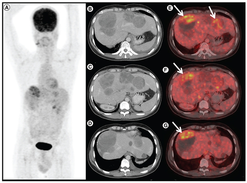 Figure 2. Response to avapritinib therapy in case 1. 1 8F-FDG positron emission tomography/computed tomography (PET/CT) done 6 months after avapritinib therapy in patient A. (A) Maximum intensity projection, (B, C & D) axial contrast enhanced CT and (E, F & G) fused PET/CT images shows increase in size of the liver lesions with FDG avid enhancing areas in the periphery of the lesion (arrows), suggestive of progressive disease.