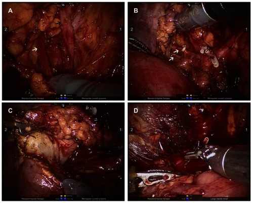 Figure 2 Surgical video screenshots of the retroperitoneal robot-assisted laparoscopic upper pole heminephrectomy. (A) The dilated upper (black arrow) and lower (white arrow) ureters were clearly identified. (B) The upper pole vessels (white arrow) were dissected free, ligated using Hem-o-lok clips. (C) By cranial traction of the proximal ureteral stump, dissection proceeded along the demarcation line between the upper and lower pole. (D) Renorrhaphy was performed.