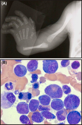 Figure 4. Phenotypic features of thrombocytopenia with absent radii (TAR) syndrome. (A) Absence of the radius. (B) Late-onset MDS in an adolescent with TAR syndrome (see Vignette 6). Radiograph courtesy of William H. McAlister, MD.