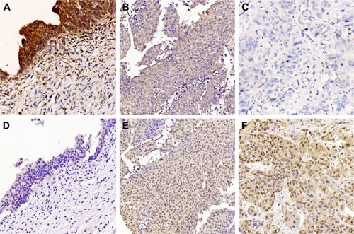 Figure 1 Expression of DOC-2/DAB2 interactive protein (DAB2IP) and phosphorylation signal transducer and activator of transcription 3 (pSTAT3) in UCB tissues and bladder urothelium controls by immunohistochemistry.