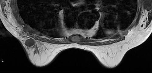 Figure 3 Breast MRI.
