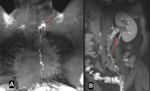 Figure 1 Dilatation TD and uro-lymphatic fistula seen on MRL. MR lymphangiography reformatted at coronal view of a 64-year-old female patient. (A) TD was tortouses and dilated at the distal part (arrow) where there was obstruction at the TD-veinous junction. (B) Dilated lymphatic vessels at the lumbar level were afferent into the left kidney (arrows).