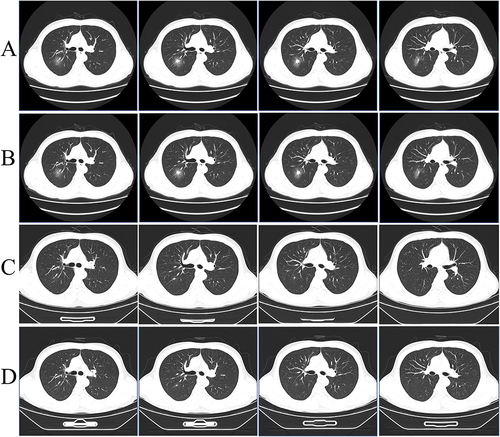 Figure 1 Chest CT image. (A) A mixed ground glass (4.2*3.7 cm) in the posterior segment of the upper lobe of the right lung on admission (2023-2-28). (B) After effective antifungal therapy, the mixed ground glass opacity (2.5*1.4 cm) in the posterior segment of the upper lobe of the right lung was reduced on March 14, 2023. (C) After effective antifungal therapy, the nodule (11*7 mm) in the posterior segment of the upper lobe of the right lung continued to reduce on April 7, 2023. (D) The nodule (approximately 8 mm) in the posterior segment of the upper lobe of the right lung continued to reduce on April 22, 2023.