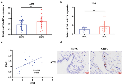 Figure 1. ATM was highly expressed in CRPC and positively associated with PD-L1 expression. a, b. Expression of ATM and PD-L1 mRNA was measured by qPCR (n = 20) in CRPC and HDPC tissues. GAPDH was used to normalize the level of mRNA expression. c. the link between ATM and PD-L1 mRNA expression was calculated using a linear correlation analysis. The Spearman correlation coefficient (r) and the accompanying p (probability) value were shown. d. ATM expression in PC tissues from patients with CRPC was evaluated by IHC analysis. Scale bar = 20 μm. Data are presented as the mean ± SD. **P < .01. Data in a and B were normally distributed and analyzed using Student’s t-tests.