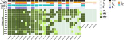 Figure 1 The clinical and pathological characters of each patient. The green bar below each patient shows the consistency of two biopsies.