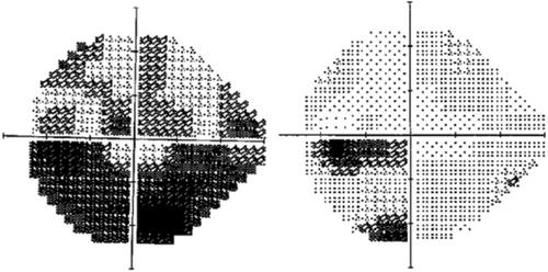 Figure 4 Visual field of the left eye at day 5 and day 60.