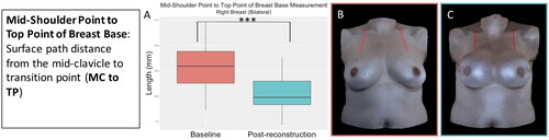 Figure 16. The mid-shoulder point to top point of breast base measurement (mid-clavicle to transition point) for the participants who underwent bilateral implant-based reconstruction significantly decreased after implant-based reconstruction (right breast: p < 0.001, left breast: p < 0.001). (A) Boxplot (median and interquartile range) of the mid-shoulder point to top point of breast base measurement at baseline and post-reconstruction for the right breast (left was similar). (B) The mid-shoulder point to top point of breast base measurement on an exemplar patient at baseline. (C) The mid-shoulder point to top point of breast base measurement on the same patient post-reconstruction.