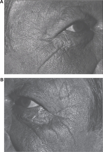 Figure 5 Photographs for subject number 3 (male) who had driven a lorry for a third of his life for 9–10 hours per day. A) Nonwindow-exposed side (his right side). B) Window-exposed side (his left side) where the wrinkles of the crow’s foot are more numerous and more marked.