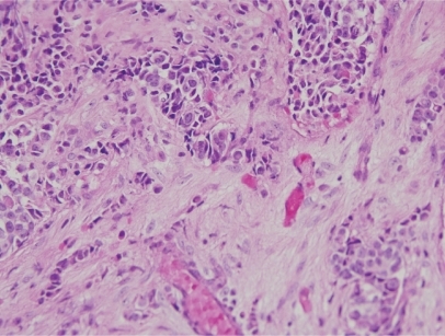 Figure 4 Case 2. Pathologic appearance of biopsy specimen. Note nests and cords of cancer cells (Hematoxylin and eosin, X200).