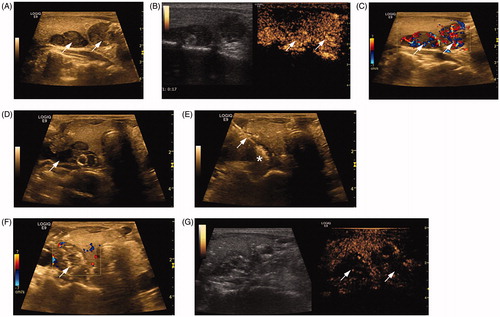 Figure 2. Ultrasound characteristics of a patient (female, 27 years old, on hemodialysis for 8 years) before and after microwave ablation (MWA). (A–C) Images of the upper and lower nodules (arrows) on the right side by two-dimensional ultrasound (A) and contrast-enhanced ultrasound (CEUS) (B) and the blood flow by color Doppler flow imaging (CDFI) (C) before MWA. (D) Saline injection into the parathyroid capsule for heat insulation. Arrow shows the separating saline interface. (E) Image of the MWA of the upper nodule. The antenna and ablating tip are shown by arrow and star, respectively. The ablation zone was evaluated through echo changes from the position of the antenna tip. (F–G) Images of the upper nodule after MWA by CDFI (F) and CEUS (G).