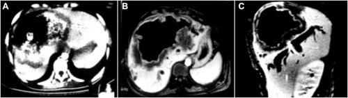 Figure 8 Alveolar echinococcosis—the CT and MRI manifestations. (A) CT imaging: A marginal, hypodense infiltration zone is observed, coexisting with both calcified deposits with irregular masses at the inner margin and a cavity. (B and C) MRI: The infiltration zone manifests as a hypodense irregular mass on T1- and T2-weighted images and the inner edge of the fibrous zone manifests as slightly hyperdense and locally invaginated to form a peninsula sign, with internal necrosis and liquefaction forming a fluid retention cavity.