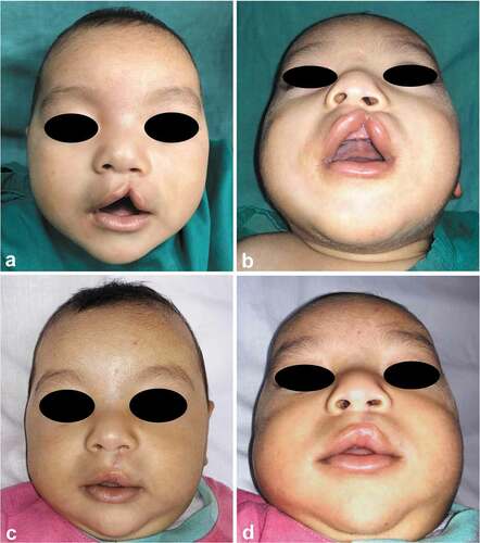 Figure 7. A case of Fisher’s group; 4-month-old male, with left-sided unilateral incomplete cleft lip. (a and b) Preoperative frontal and submental views and (c and d) 2 months’ postoperative frontal and submental views