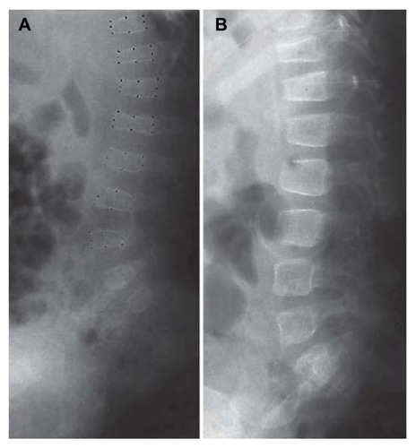 Figure 1 Vertebral bodies before (A) and after (B) treatment for 14 months for a child with Type I osteogenesis imperfecta.