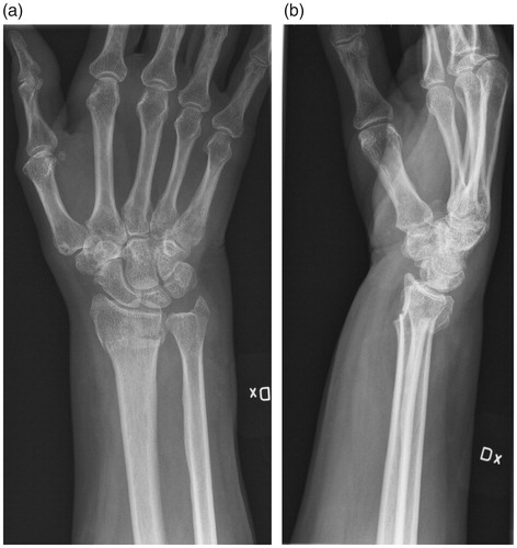 Figure 1. Initial CR of a 59 year old woman with a comminute intra-articular distal radial fracture and a fracture of the ulnar styloid process. (a) AP view. (b) Sagittal view showing dorsal tilting of the radial articular surface.