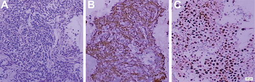 Figure S2 A biopsy specimen obtained from a patient with undifferentiated nonkeratinizing nasopharyngeal carcinoma: (A) hematoxylin-eosin staining (×100); (B) cytoplasmic staining of latent membrane protein 1 by immunohistochemistry (stained in brown) (×100) (C) in situ hybridization for Epstein–Barr virus-encoded small RNA (positive, stained in brown, ×100).