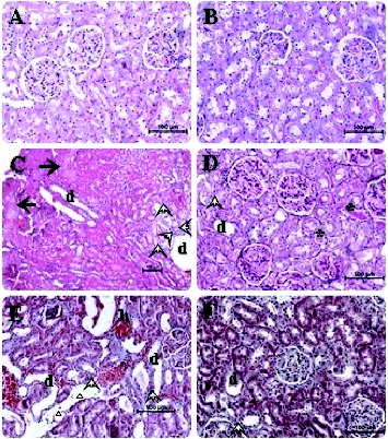 Figure 1. Photomicrographs of hematoxylin and eosin stained sections of kidney of rats (kidney histology magnification 200×). Typical features of normal histological appearence of the corticomedullary region of rat kidney sections are observed in control and EP administered groups (A, B). In kidney sections of cisplatin pretreated rats, marked changes were observed in tubulus and glomerule structures. In some corticomedullary regions focal tubular necrosis (big solid arrows), haemorrhagia (small letter h) and dilatation (small letter d) as well as inflammatory cell infiltration (small hollow triangle) in the intersititium can be seen. Furthermore, necrotic cell debris and vacuolization (arrow heads) in tubulus epithelium and protein casts in tubular lumina are evident (C, E). The sections obtained from the cisplatin + EP group are found almost similar to that of those in the control group. Rare inflammatory cell infiltration, minimal (asteriks symbols) tubular dilatation and vacuolization images can be seen. It is considered that the renal injury induced by cisplatin is prevented to a great extent by EP co-administration (D, F).
