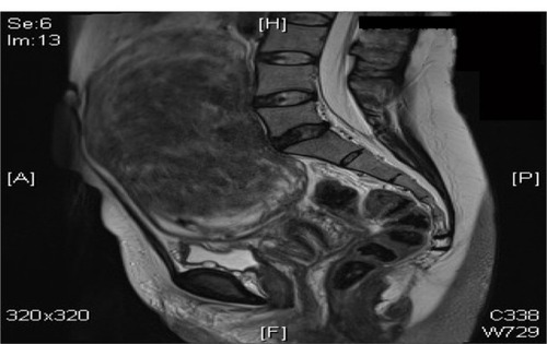 Figure 3 A 47-year-old woman with a hugely enlarged uterus. The fundus is at the level of L3. It contains a solitary large intramural fibroid which is mostly right sided, displacing the cavity to the left. This fibroid measures approximately 14.2 × 10.9 × 8.8 cm.