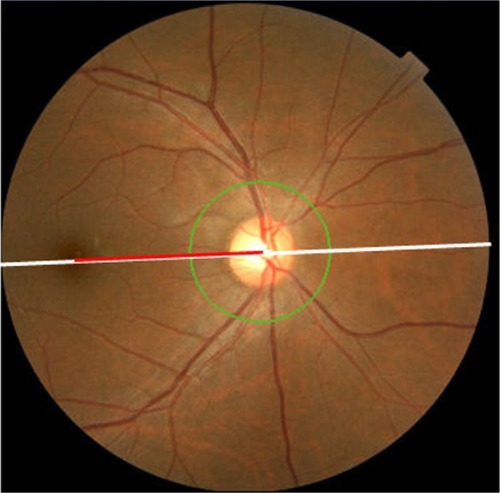 Figure 2 Measurement of ODF angle.Note: ODFangle=RedlinelenghtWhitelinelenght×45.