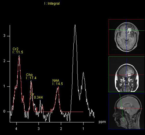 Figure 2 Magnetic resonance spectroscopy (MRS) of the brain. The lesion in the left frontal lobe showed an increased choline peak and a suppressed N-acetylaspartate peak.