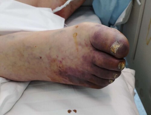 Figure 2. Ischemic changes of toes in one COVID-19 patient with severe type.