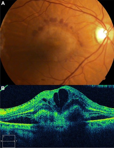 Figure 17 Choroidal neovascularization in age-related macular degeneration.